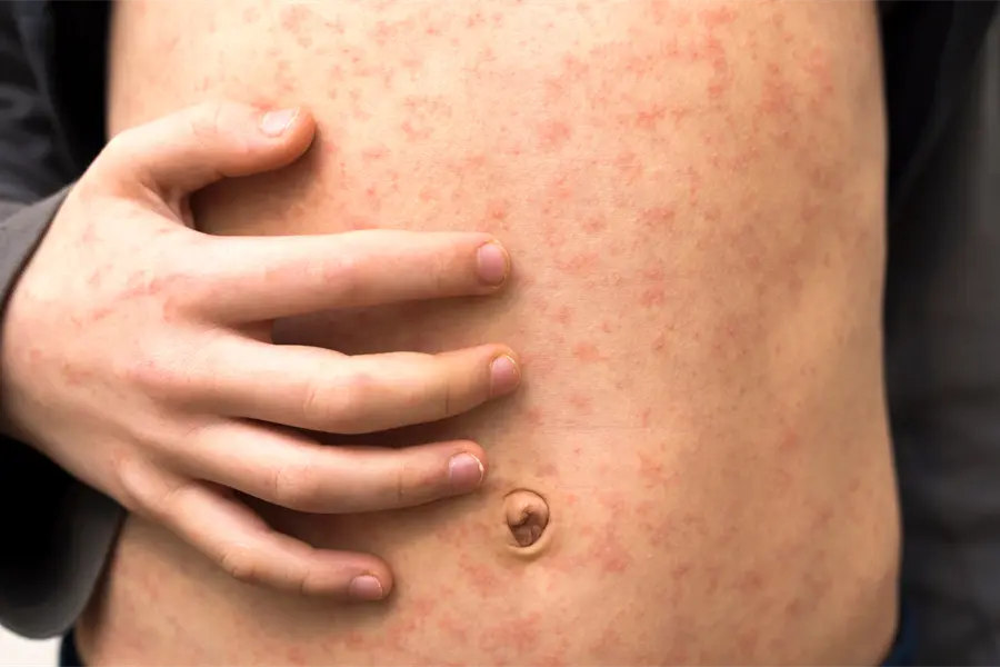 Querétaro analiza mega jornada de vacunación contra el sarampión tras nuevos casos importados