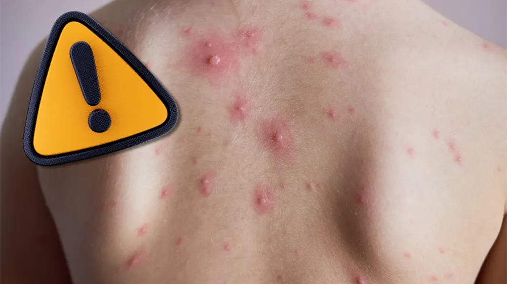 Al alza casos de varicela en Coahuila, piden reforzar medidas en población vulnerable