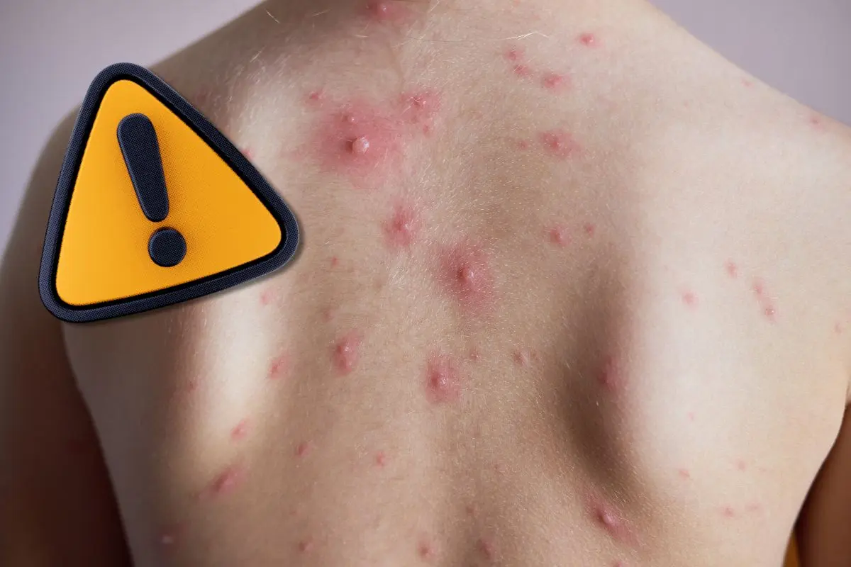 Persona con varicela representando la alza de casos en Coahuila / Foto: Composición de Canva