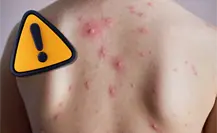 Al alza casos de varicela en Coahuila, piden reforzar medidas en población vulnerable Al alza casos de varicela en Coahuila, piden reforzar medidas en población vulnerable