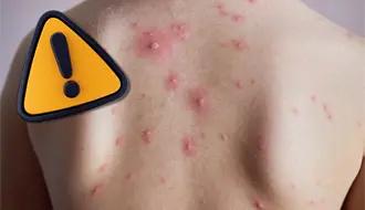 Al alza casos de varicela en Coahuila, piden reforzar medidas en población vulnerable