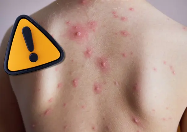 Al alza casos de varicela en Coahuila, piden reforzar medidas en población vulnerable