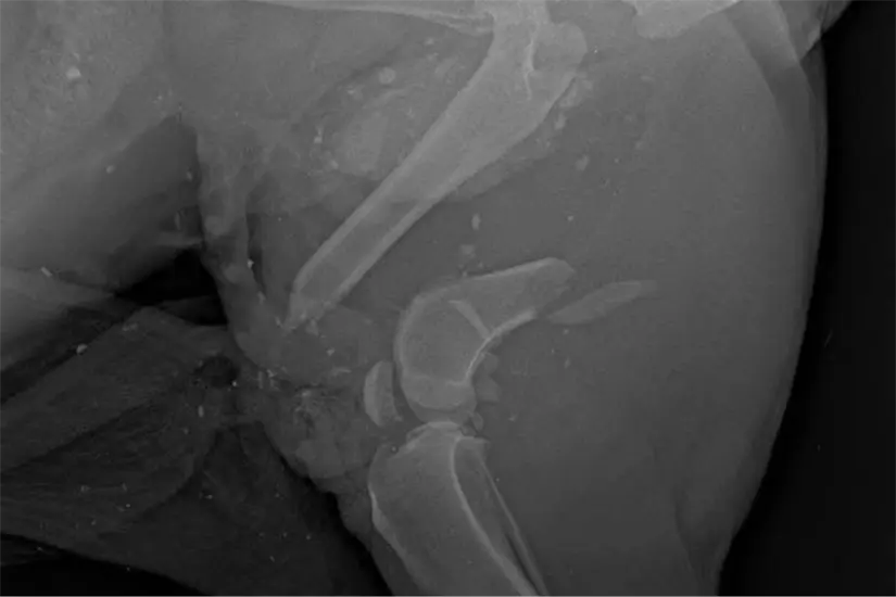 imagen recuadro Fracturas sufridas por